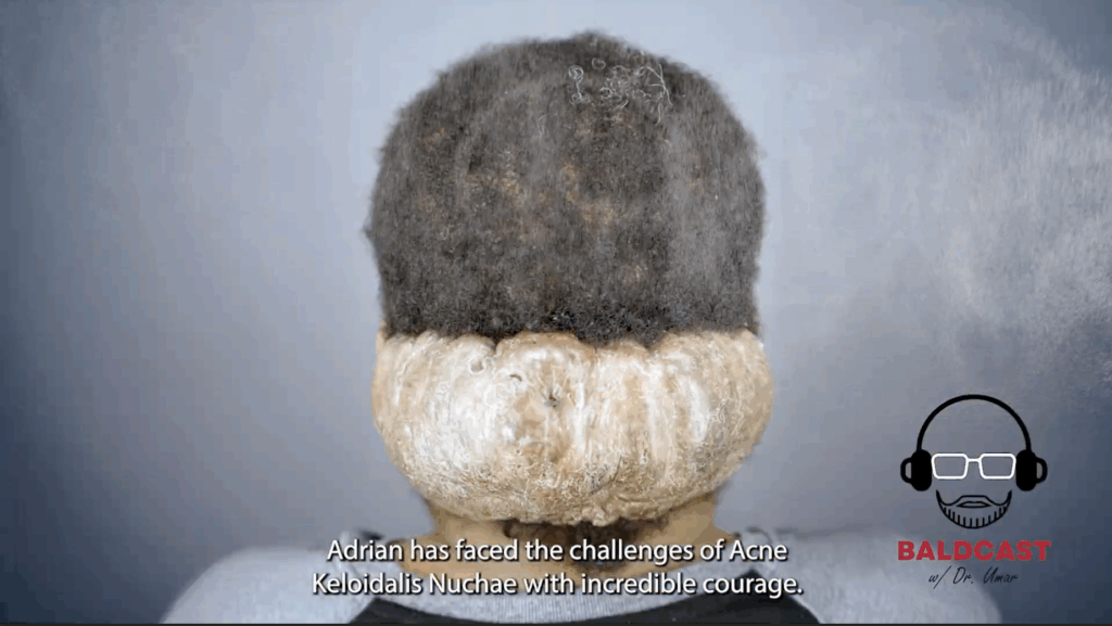 Adrian would hide the large Acne Keloidalis Nuchae (AKN) mass with beanies and hoodies, despite feeling uncomfortable in them.