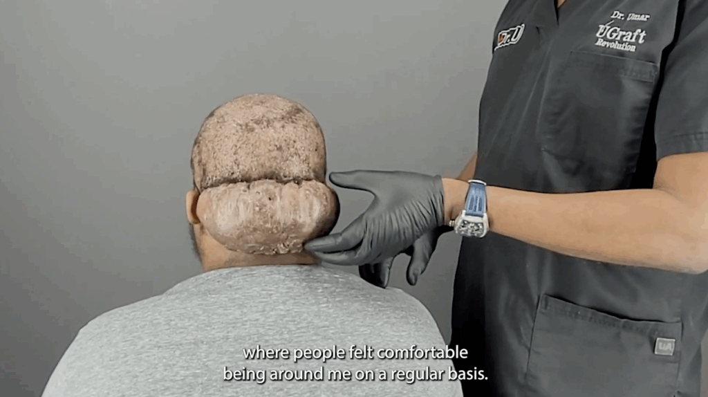 Dr. Sanusi Umar examines the large Acne Keloidalis Nuchae (AKN) mass on the back of Adrian’s head. It has negatively affected Adrian’s confidence and self-worth for eight years.