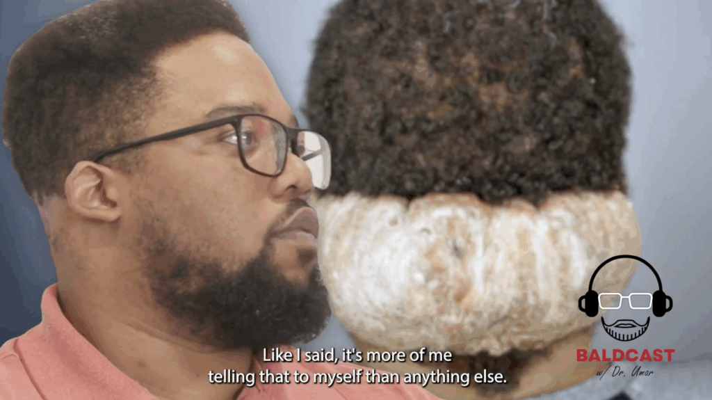 Adrian was paranoid about how people perceived his AKN scalp bump. He felt that he could not achieve his career goals because his skin condition held him back and negatively affected his confidence.
