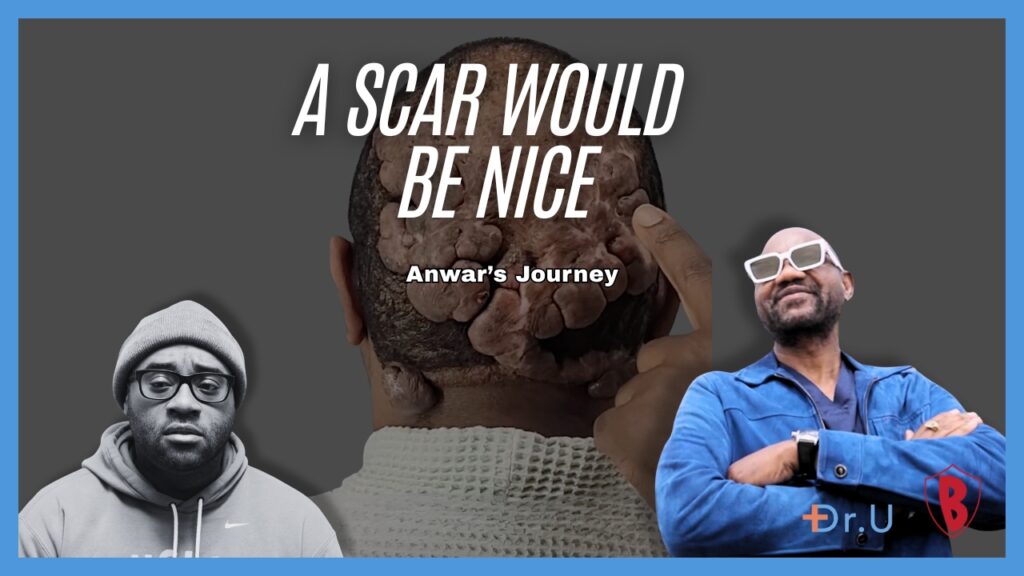 A Scar Would Be Nice: Anwar Hopes for Complete Removal of the Folliculitis Decalvans Mass