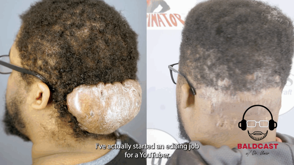 Before and after Adrian’s AKN removal surgery with Dr. Umar.