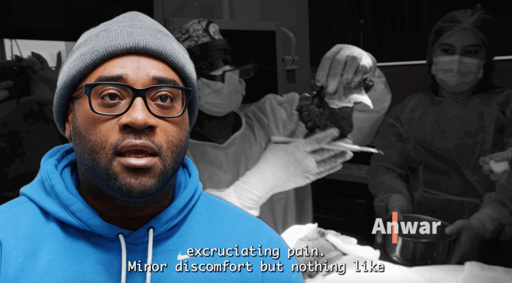 Anwar mentions he did not feel any excruciating pain after the surgery. He only experienced minor discomforts.