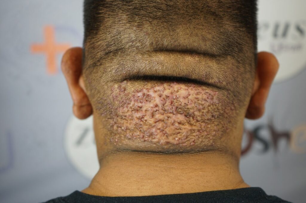 AKN scalp plaque on the back of Antonio’s head causing physical discomfort and emotional distress from Acne Keloidalis Nuchae.