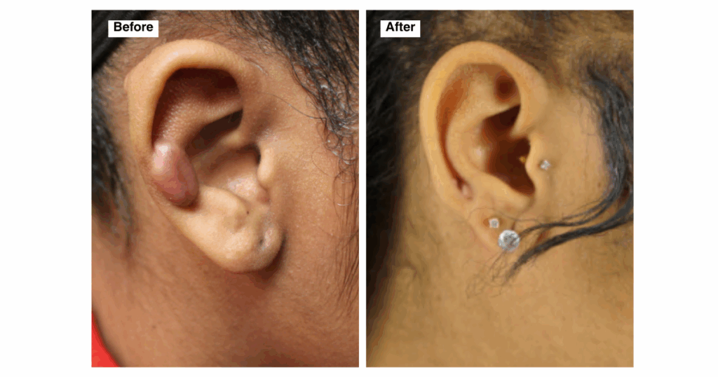 Before and after images of earlobe keloid removal by Dr. Sanusi Umar. Left image shows a large keloid distorting the earlobe. Right image shows a fully healed, natural-looking earlobe with no visible scar and newly placed earrings.