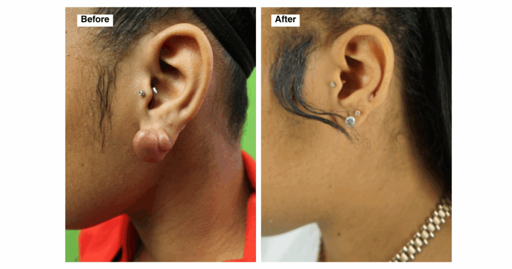 Before and after photo of patient’s split ear keloid removal by Dr. Umar. Image shows successful surgical excision and earlobe repair with natural, scar-minimized results.