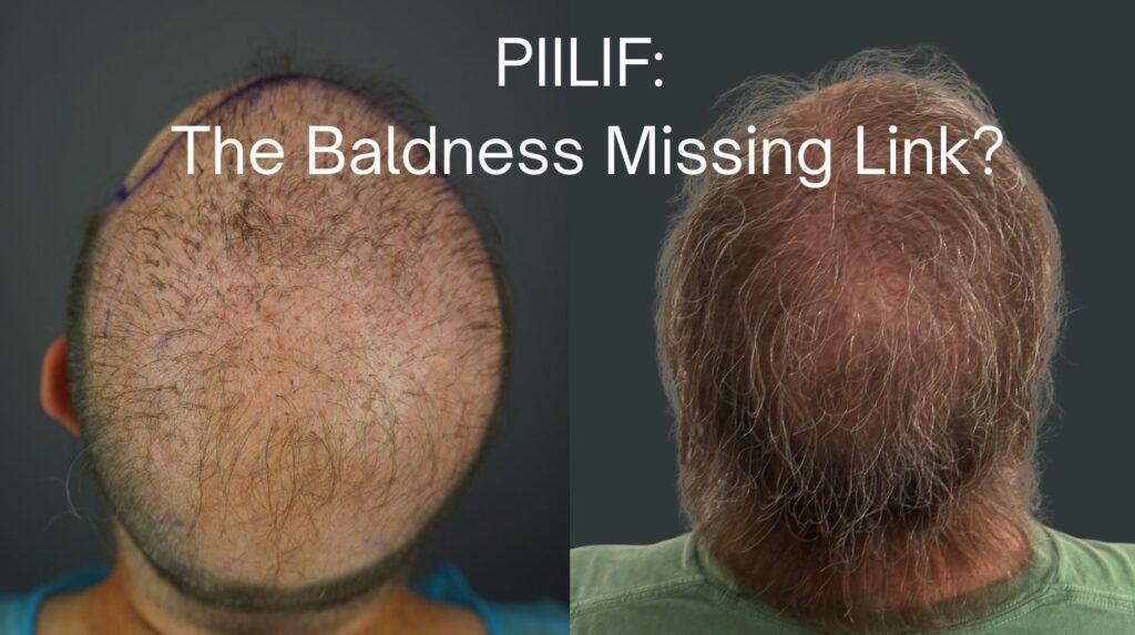 Bird’s-eye before-and-after images of a Norwood 7 androgenetic alopecia patient showing minimal hair growth before treatment and increased coverage after hair transplantation performed in conjunction with PIILIF-directed treatment.