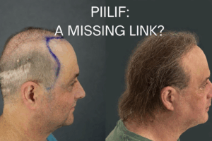 Before-and-after profile photos of a Norwood 7 pattern baldness patient with a strip-surgery scar, showing increased hair coverage 8 months after hair transplant performed in conjunction with PIILIF treatments.