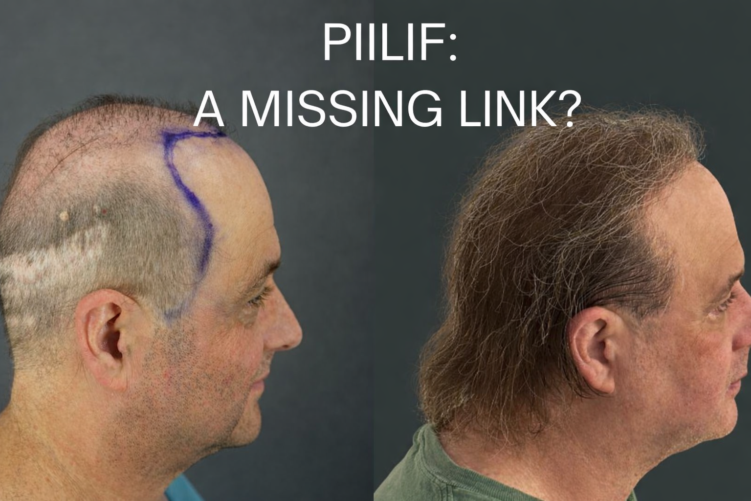 Before-and-after profile photos of a Norwood 7 pattern baldness patient with a strip-surgery scar, showing increased hair coverage 8 months after hair transplant performed in conjunction with PIILIF treatments.
