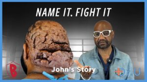 Naming and Fighting the Chronic Hairline Bumps