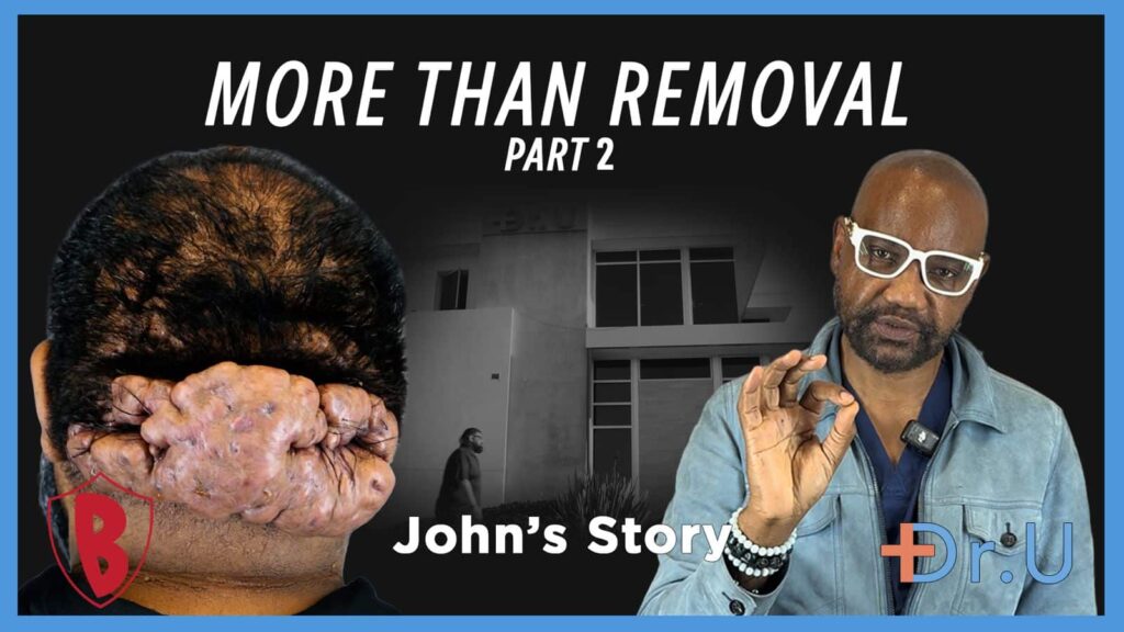 More Than the Removal of Posterior Scalp Scarring Disorder (Part 2)