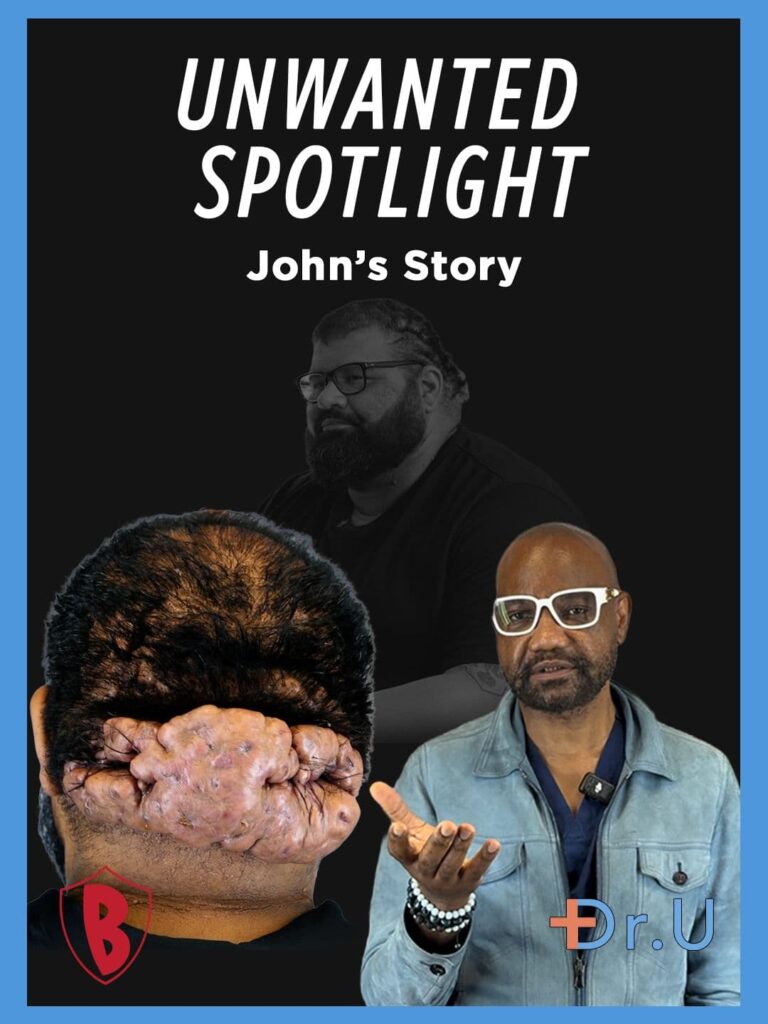 The Unwanted Spotlight Due to Inflamed Scalp Cysts