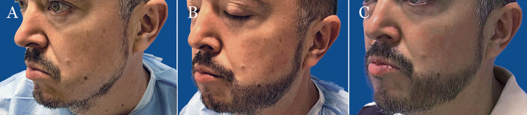 As shown in the publication, long-hair FUE results on beard restoration. 1412 long-shafted grafts were implanted on the beard area to create a full facial hair look.