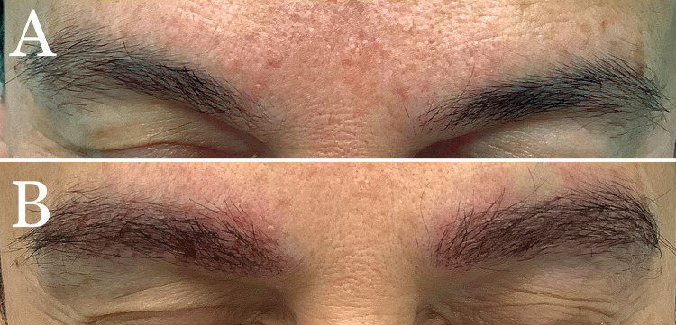 As shown in the publication, before and after results of a woman who underwent long-hair FUE for eyebrow restoration.