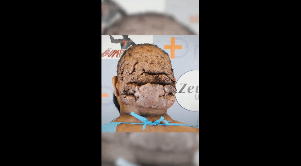 John’s condition which shows the bumps on the back of the head and scalp boils.