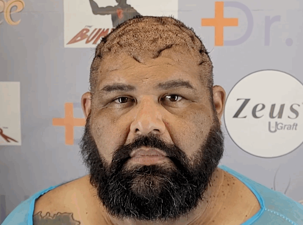 John came into the Bumpinator clinic with complex current scalp conditions that looks like bumps and draining boils