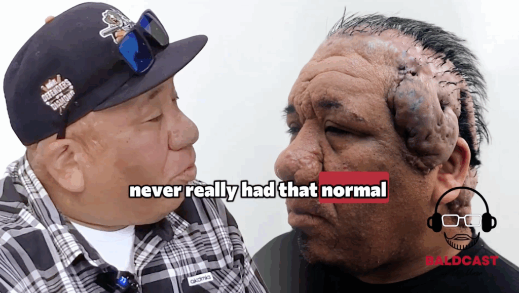 For 27 years, Robert lived with Acne Keloidalis Nuchae and Cutis Vertices Gyrata, which manifested in large, keloid-like bumps and folded ridges on his scalp.