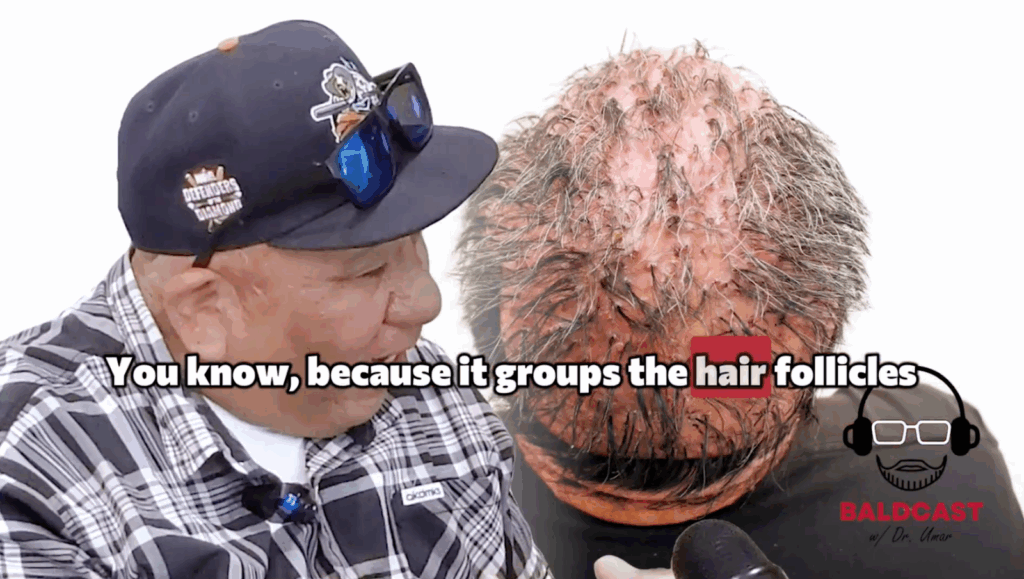 As Robert’s AKN condition worsened, ridges formed on his head and clumps of hair started to tuft together. It made him feel like he wasn’t normal.