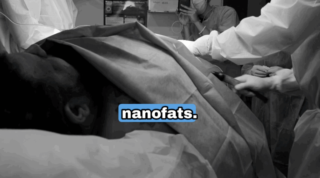 Dr. Umar, the Bumpinator, is extracting nanofats from John’s abdomen. These nanofats are known for their regenerative properties which will help with John’s recovery and healing.