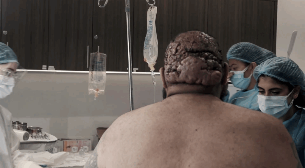 John is getting ready for his surgery, and the surgical team is preparing him for the procedure to remove the AKN lesions.