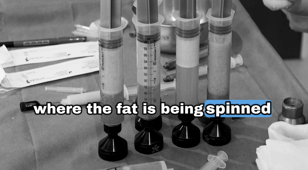 The nanofat taken from John’s abdomen is spinned and filtered.