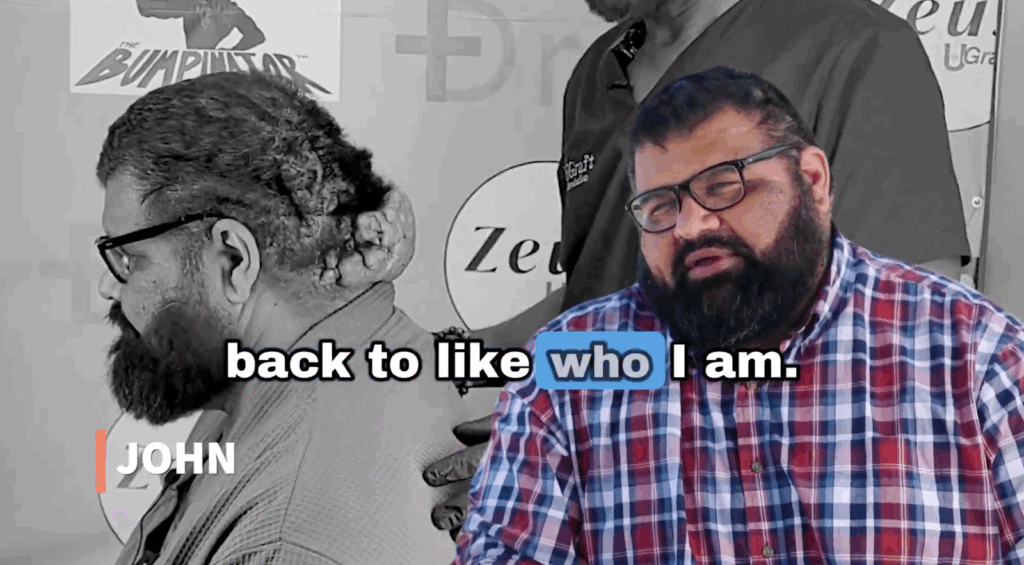 John is looking forward to the positive outcomes of the procedure, he is excited to be back to who he was before he has his scalp condition.