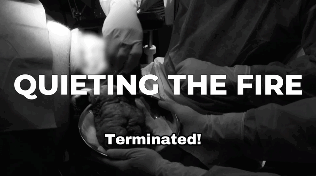 Dr. Sanusi Umar has finally removed the diseased scalp bumps on John’s scalp.