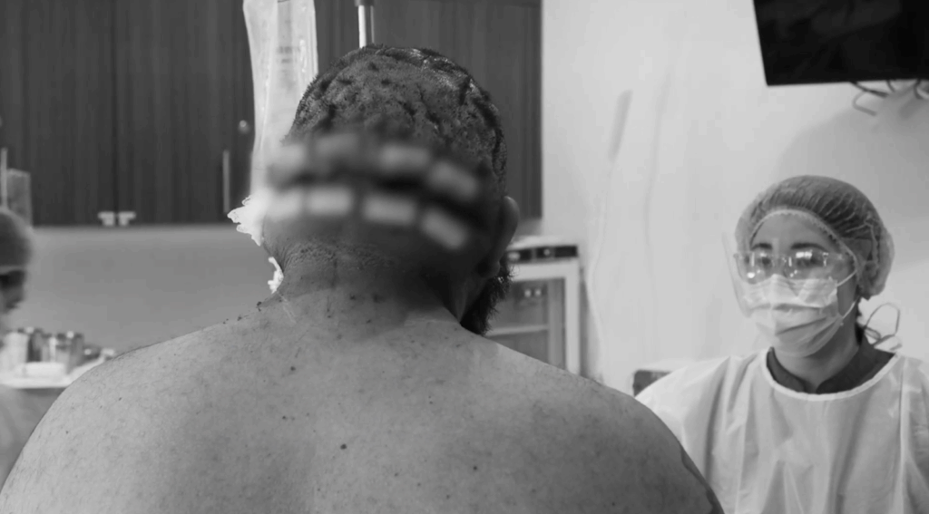 John’s back of the head  free of scalp bumps after the surgery.