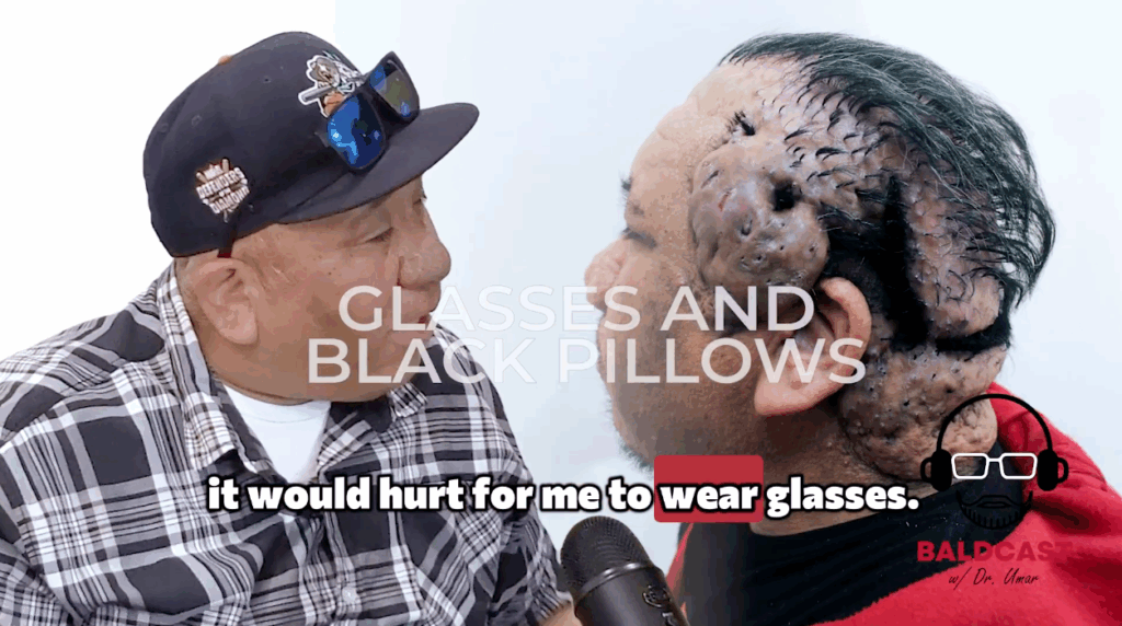 When his scalp disorder started to worsen, Robert could no longer wear any type of glasses, whether prescriptions or sunglasses.