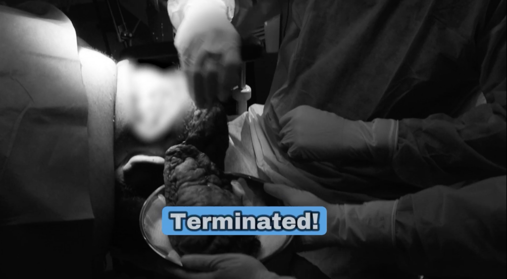 Dr. U successfully terminated the huge scalp lesion off of John’s head.