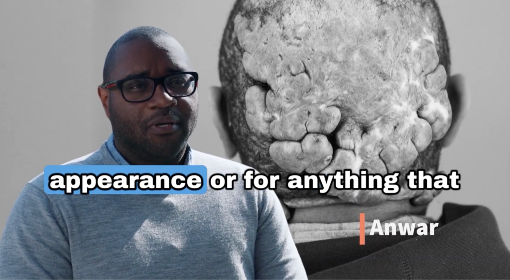 Anwar states that after his surgery and recovery, he had noticed that people no longer look at him indifferently because of his appearance unlike when he had the big keloids on the scalp.