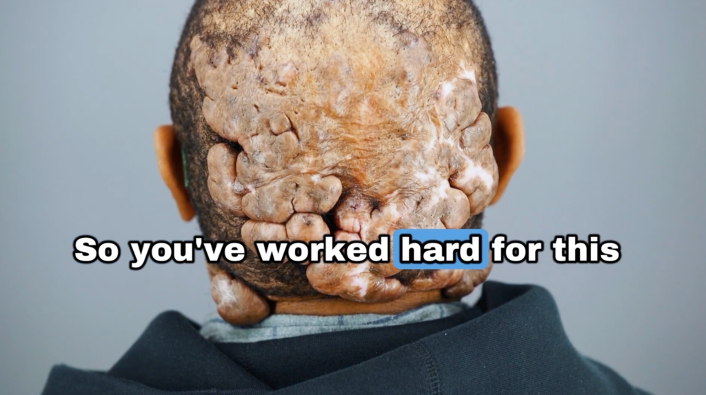 Anwar’s previous condition having a huge lump of razor bump on his head before having the consultation and surgery done by Dr. Umar. 