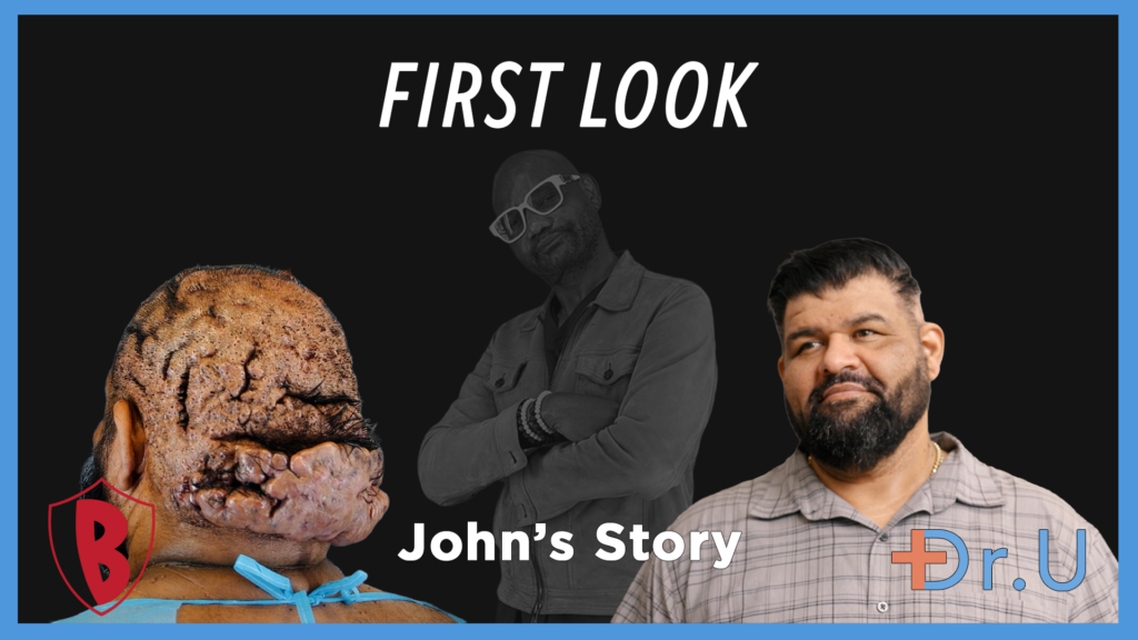 Impact from Scalp Keloids on the Life of John