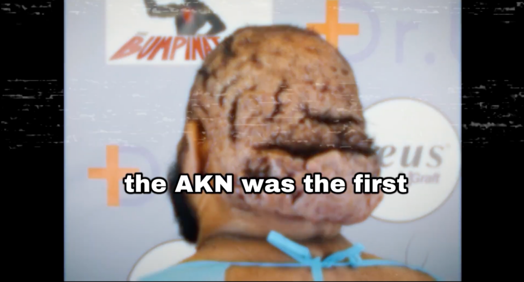 Chronic folliculitis of the nape or AKN, was the first to appear on John’s scalp before other scalp conditions grew.