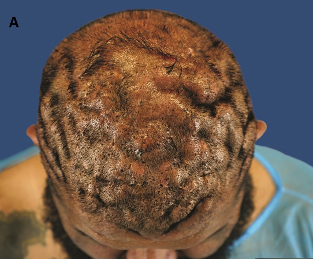 PIILIF in Dissecting Cellulitis: What Paired Biopsies Reveal Across Normal-Appearing Scalp, Quiet Nodules and Active Lesions