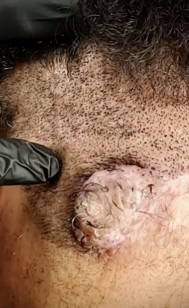 Close-up of the lower scalp with short hair surrounding a large raised skin area with visible hair and surface texture