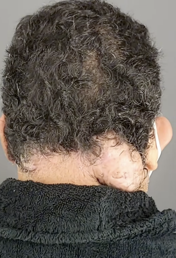 Rear view of a patient’s head with curly dark hair and a large raised area at the lower scalp near the neck.