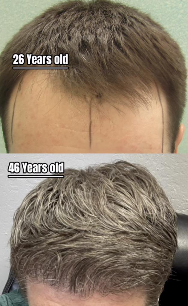 Stacked frontal hair comparison labeled 26 Years old and 46 Years old.