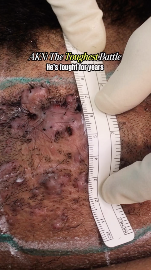 Close-up of a scalp area with visible raised skin changes and a ruler held beside it by gloved hands.