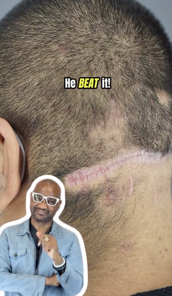 Side and rear view of closely cut hair with a lighter linear area near the lower hairline and Dr. Umar pictured in front.