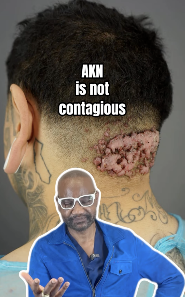 Rear view of a patient’s head with a raised area at the lower hairline and the words AKN is not contagious.