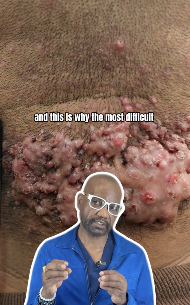 Close view of multiple raised bumps across the lower scalp with Dr. Umar pictured in the foreground.