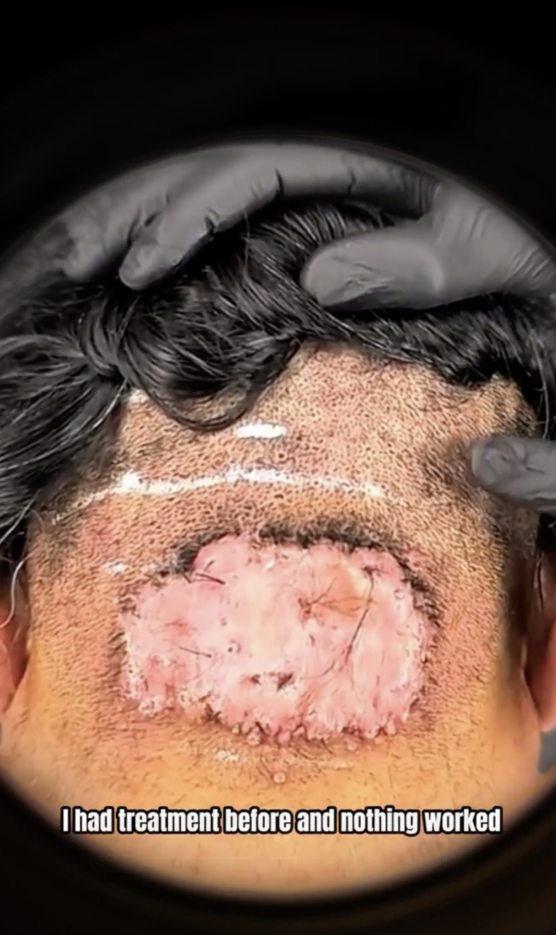 Rear close-up of the lower scalp with hair held aside and a large raised pink area.
