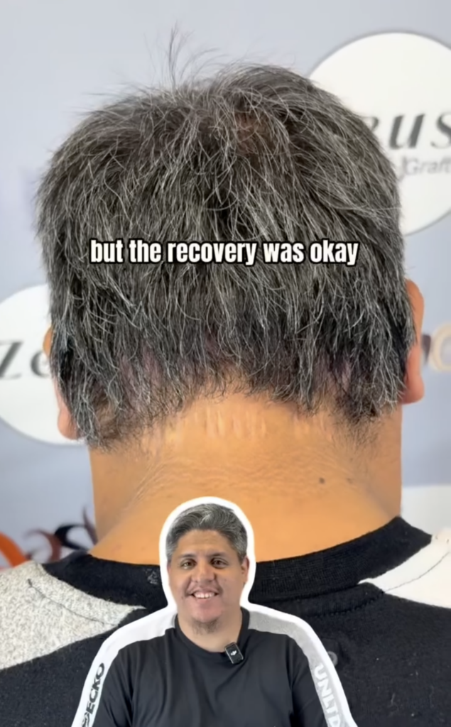 Rear view of gray hair and the lower hairline with the patient pictured in front and text about recovery.