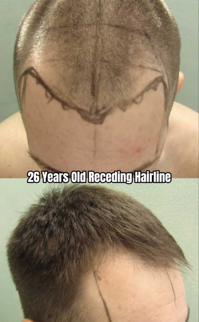 Two frontal hairline views labeled age 26, including one with closely shaved hair and drawn hairline markings.