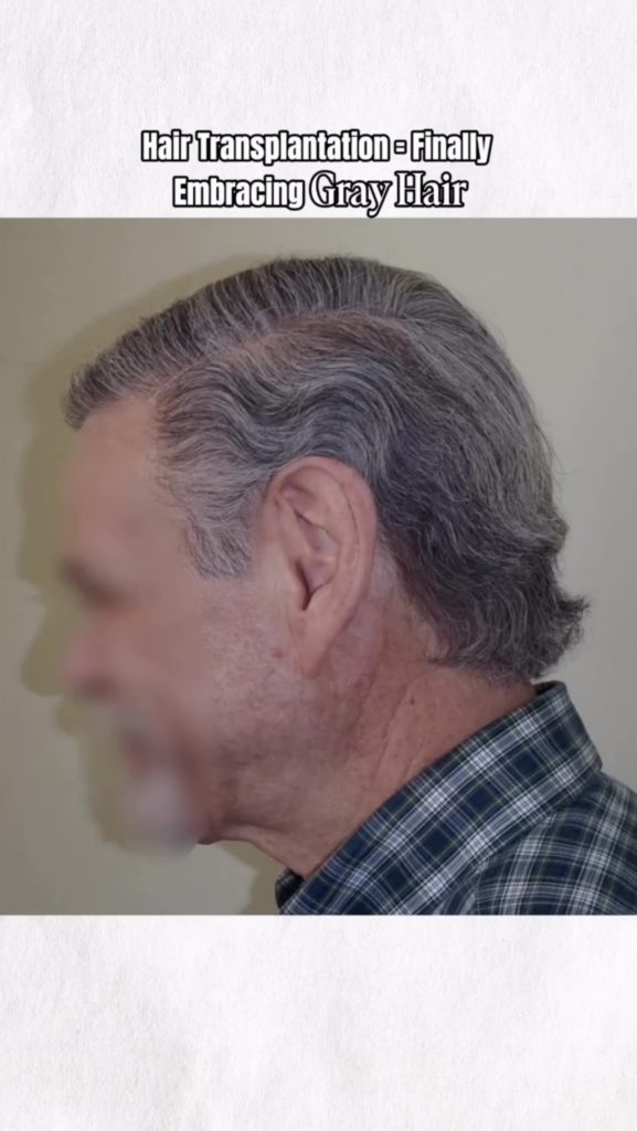 Side profile of a patient with longer natural gray hair styled back from the forehead.