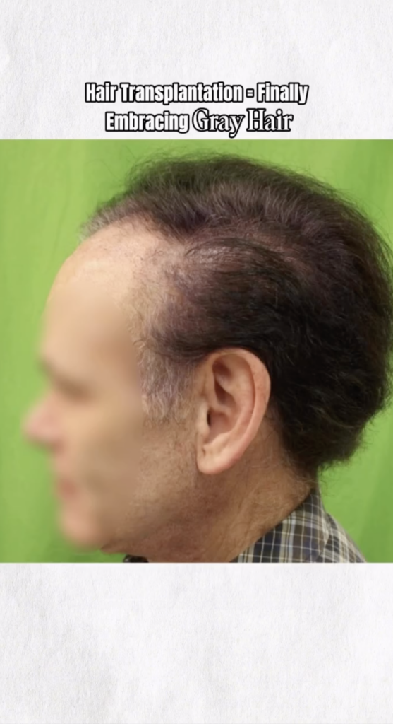 Side profile of a patient with dark hair and visible thinning near the frontal hairline and temple.