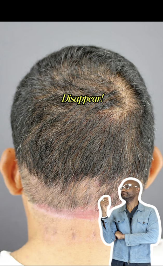 Back of a head with short hair and a pink linear band across the lower hairline.