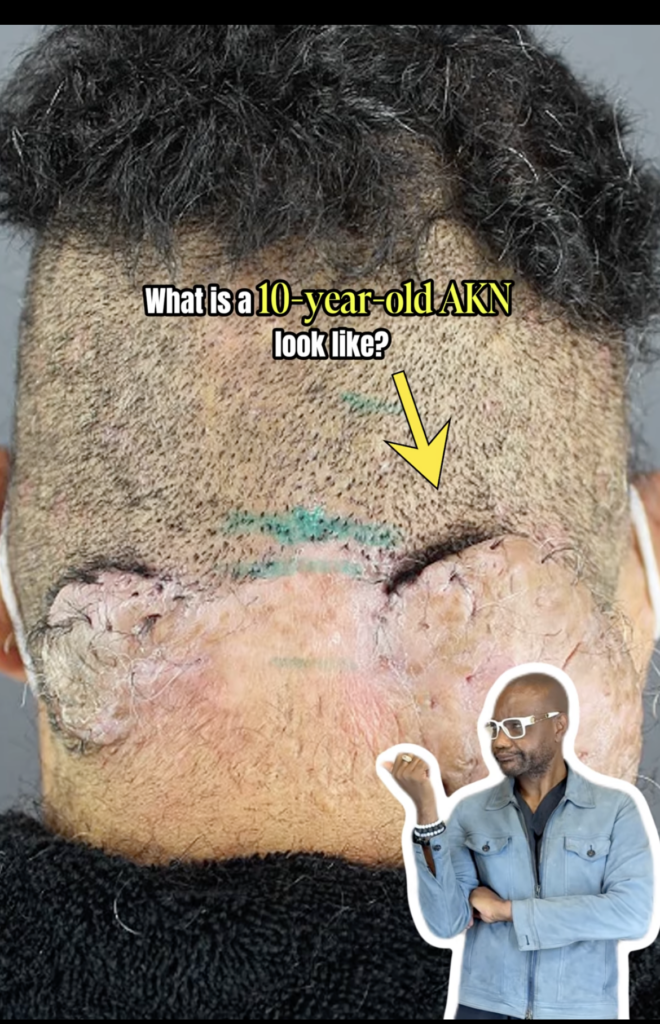 Back of a scalp with a large raised irregular area near the lower hairline and green markings above it.