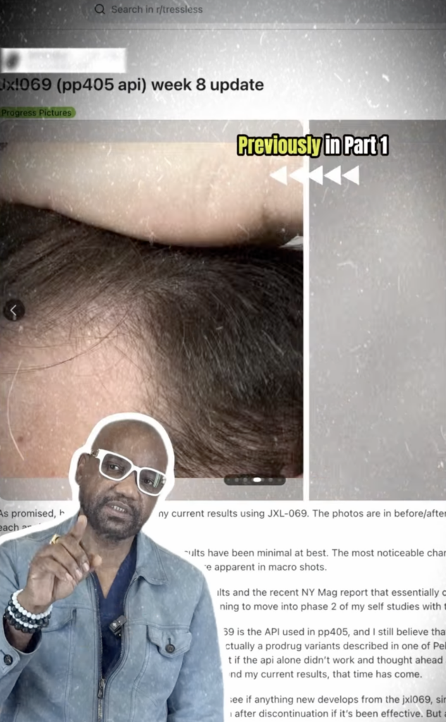 Scalp progress post shown behind Dr. Sanusi Umar during a PP405 video discussion.