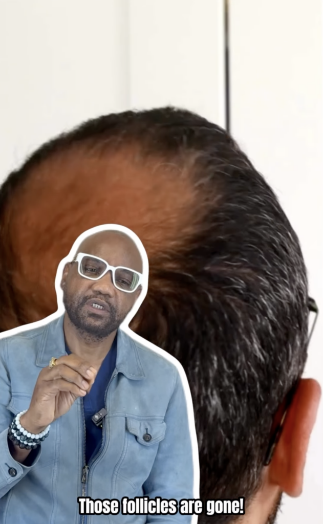 Back and top view of a man's scalp with Dr. Sanusi Umar pictured in the foreground.